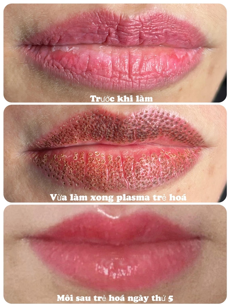 Kỹ Thuật Plasma Fibroblast - 1